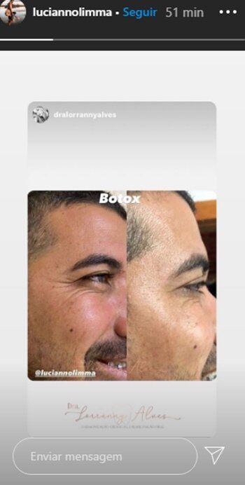 Irmão de Gusttavo Lima mostra antes e depois de ter feito Botox com a doutora Lorrânny Alves Irmão de Gusttavo Lima mostra antes e depois de ter feito Botox com a doutora Lorrânny Alves