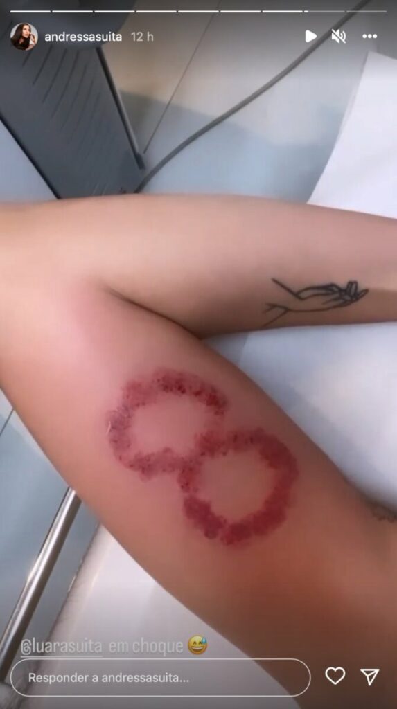 Andressa Suita sofre para remover tatuagem com símbolo do infinito que fez para amiga  